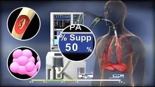 Proportunal Assist Ventilation Plus (PAV+)
