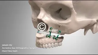 Corrective Jaw Surgery Orthognathic
