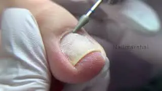Педикюр/ эстетика в педикюре/ арочные ногти /высокие валики 