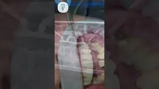 К нам приходят из других клиник и мы исправляем вот такие ситуации. Имплантация Зубов.
