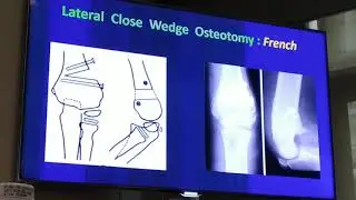 Rotational Elbow Deformity