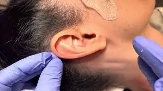 Do I neeed an otoplasty or macrotia surgery?