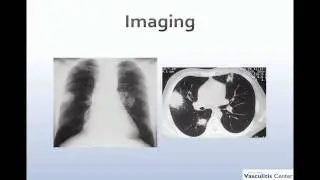 ANCA-associated vasculitides and anti-GBM disease:  a nephrology primer