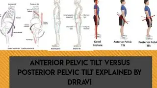 Anterior Pelvic Tilt Versus Posterior Pelvic Tilt Explained By DrRavi