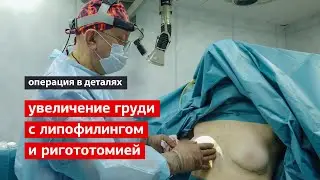 Breast augmentation with lipofilling and rigotomy – the operation in detail – Alexander Petrovich...