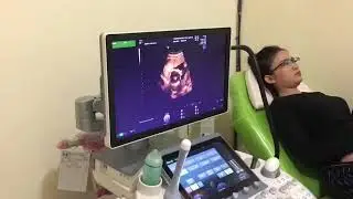 USG 5 bulan melihat wajah janin dan jenis kelamin janin placenta previa