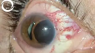 Ciliary body melanoma