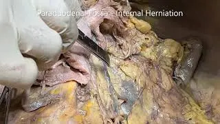 DUODENUM D-J FLEXURE Pancreas Superior Mesenteric and PD Arteries with Clinicals – Sanjoy Sanyal