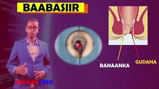 baabasiirka waxa sababa sida lagu garto iyo daawadiisa