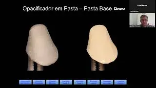 Extratificação com Ceramco 3 | Dentsply Sirona