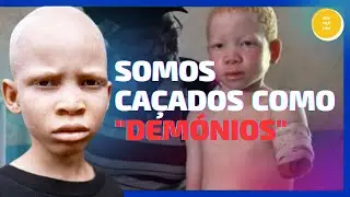 A PERSEGUIÇÃO DE ALBINOS NA TANZÂNIA 😰😰