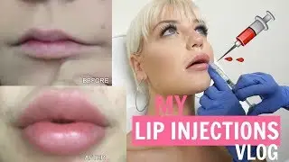 LIP INJECTIONS VLOG: TIPS & THINGS YOU SHOULD KNOW!