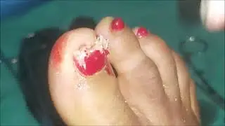 Ingrown Toe Nail Removal