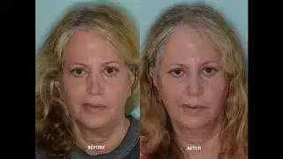 Revision Rhinoplasty for a Severely S-shaped Crooked Nose | Dr. Anthony Bared, MD, FACS Miami, FL