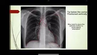 CXR basics - Line placement and ETT verification