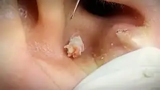 Very Satisfying Satisfying Pimple POP | Blackheads Remove 2024
