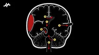 Brain Herniation Syndromes