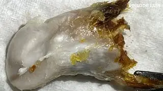 1,559 - Grade II Keratosis Obturans Removal