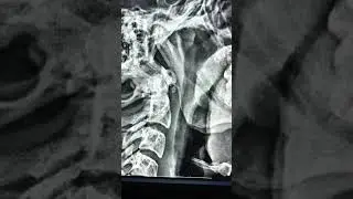 Accessory ossicle of Anterior arch of atlas - Normal variant