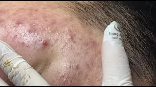 Acne treatment for Hoang (P.5) #HoangMySpa115