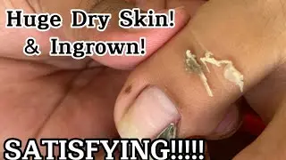 Relaxing and Satisfying Cleaning of Toenails: (Pedicure) Ingrown Removal #ingrownremoval #ingrown