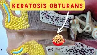Why Keratois obturans is so aggressive ? Keratosis obturans Vs Cholesteatoma