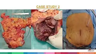 Technical Aspects Of Performing Intracorporeal Anastomosis In Laparoscopic Right Hemicolectomy