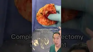 Treating a Waterfall Deformity and Capsular Contracture! 