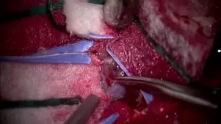 ОГМ левой височной области   видеолекция 1