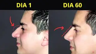 Cómo Reducir tu Nariz de Forma Natural en Casa
