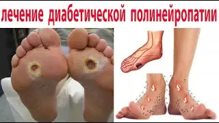Болят стопы, немеют пальцы, ползают мурашки -лечение диабетической полинейропатии. Язва стопы