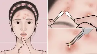 ASMR Acne Treatment At Home | Pimple, Acne Removal Animation | Meng's Stop Motion