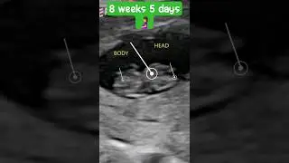 8 Weeks 5 Days Ultrasound: Baby's First Heartbeat and Development!!