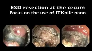 ESD at the cecum with ITKnife nano