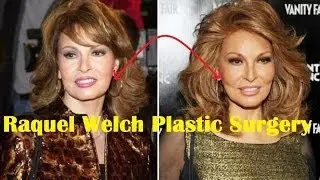 Raquel Welch Plastic Surgery Before and After