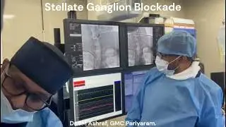 Stellate Ganglion Blockade for Recurrent VT