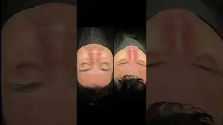 Revision Rhinoplasty Before After: Allogenic Tutoplast Costal Cartilage Used