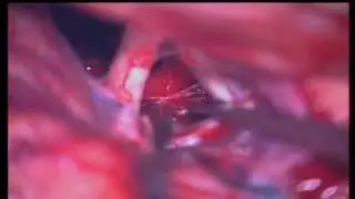 Craniopharyngioma (Kraniofarengioma)