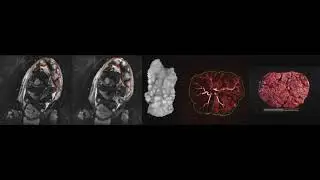 Using MRI to Visualize the Placenta