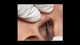 CRAVO GIGANTE na orelha 👂