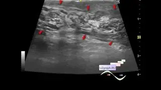 Pediatric Scrotal Ultrasound - Postoperative Funiculitis/ Epididymitis