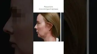 Лігатурна підтяжка - це ліфтинг обличчя без розрізів, за допомогою ниток. 