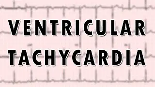 Ventricular Tachycardia