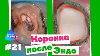 Коронка после Эндо  | Дентал Кейсы от BG #21