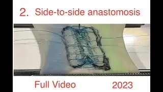 Side-to-side bowel anastomosis, alternative 2024, extended