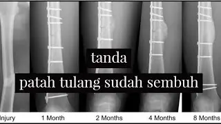 patah tulang, tanda sudah sambung atau sembuh?