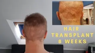 hair transplant result 8 weeks turkey