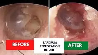 Successful repair of eardrum perforation