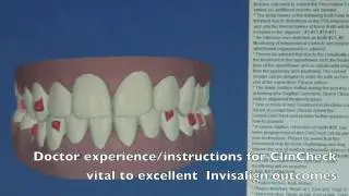 Invisalign ClinCheck Explanation