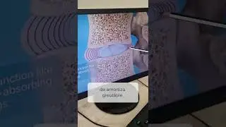 Hernia de disc 
